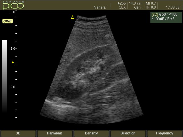 Kidney, B-mode (echogramm №245)