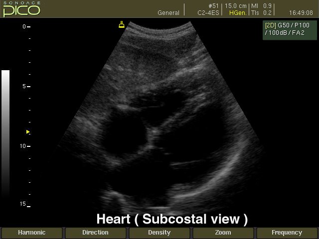 Heart (subcostal view), B-mode (echogramm №246)