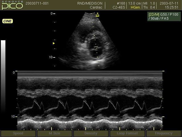 Mitral valve, M-mode (echogramm №248)