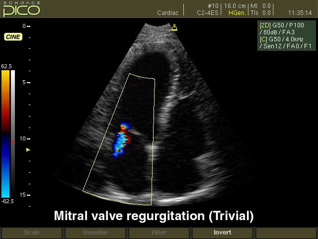 Mitral valve regurgitation, color doppler (echogramm №249)