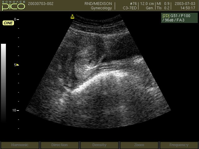 Uterus, B-mode (echogramm №252)