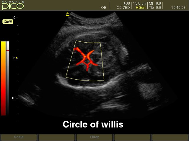 Circle of Willis, power doppler (echogramm №254)