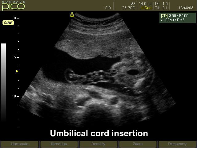 Umbilical cord insertion, B-mode (echogramm №256)