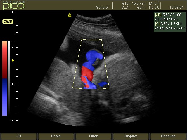 Umbilical cord, color doppler (echogramm №257)