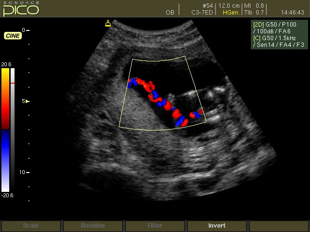 Umbilical cord insertion, color doppler (echogramm №259)