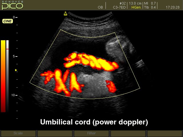 Umbilical cord, power doppler (echogramm №260)