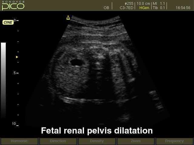 Fetal renal pelvis dilatation, B-mode (echogramm №261)