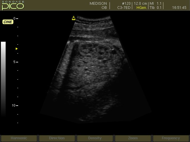 Fetal kidney, B-mode (echogramm №262)