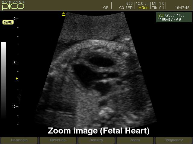 Fetal heart, B-mode (echogramm №263)