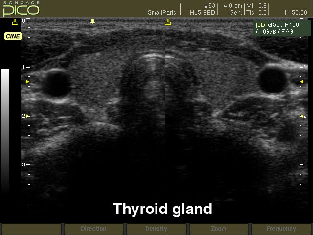 Thyroid, B-mode (echogramm №264)