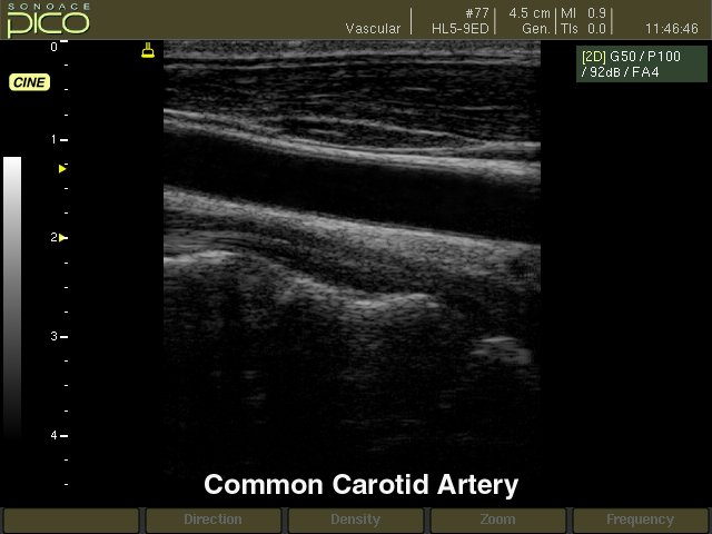 Common carotid artery, B-mode (echogramm №266)