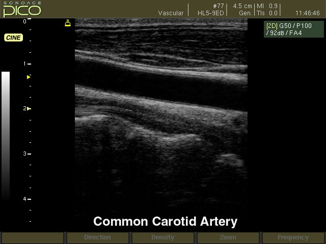Common carotid artery, B-mode (echogramm №266)