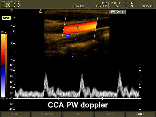 Common carotid artery, CFM & PW (echogramm №267)