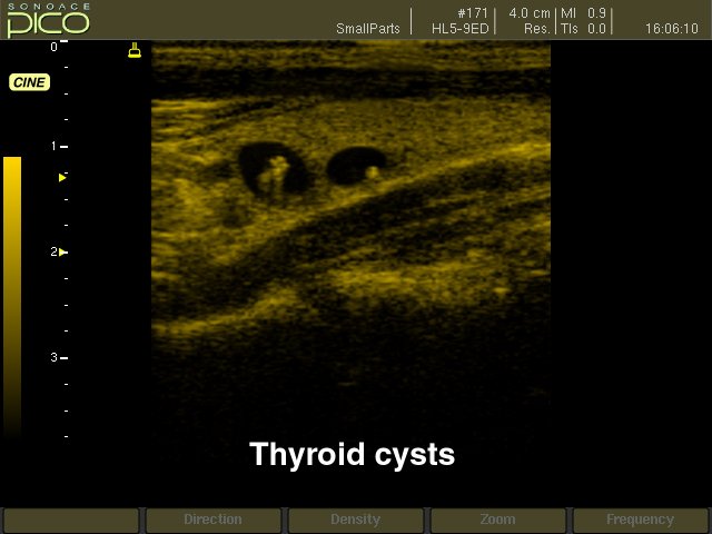 Thyroid cyst, B-mode (echogramm №268)
