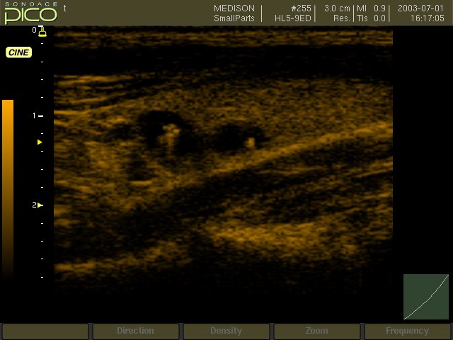 Thyroid cyst, B-mode (echogramm №269)