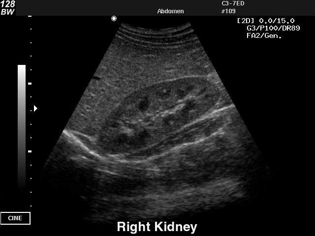 Kidney, B-mode (echogramm №27)