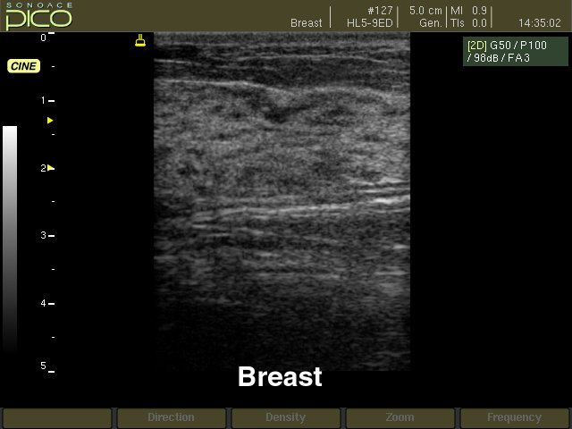 Breast - norm, B-mode (echogramm №270)