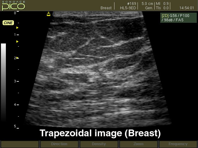 Breast, trapezoidal B-mode (echogramm №271)