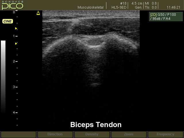 Biceps tendon, B-mode (echogramm №276)