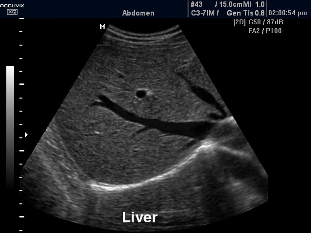 Liver, B-mode (echogramm №279)