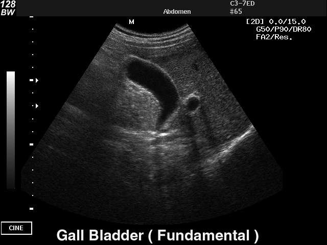 Gall bladder - fundamental harmonic, B-mode (echogramm №28)