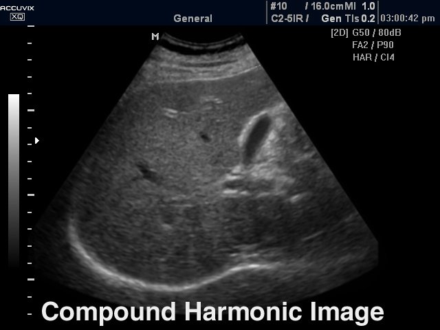 Liver, compound harmonic mode (echogramm №281)