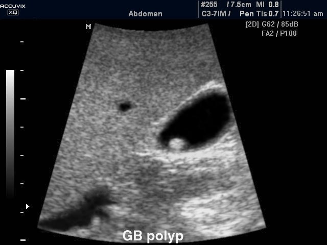 Gall bladder polyp, B-mode (echogramm №282)