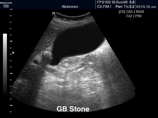 Gall bladder stone, B-mode (echogramm №283)