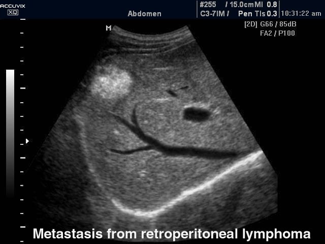 Liver - metastasis from retroperitoneal lymphoma, B-mode (echogramm №284)