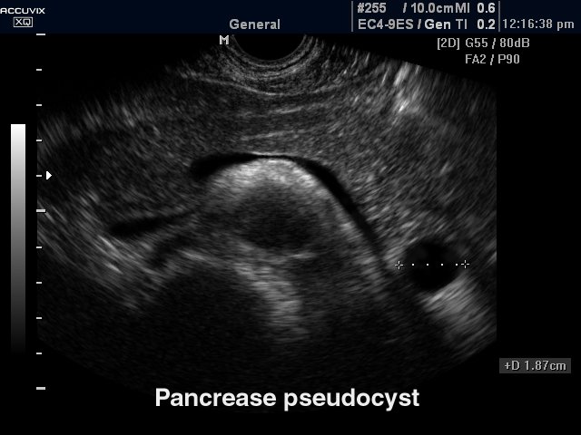 Pancrease pseudocyst, B-mode (echogramm №286)
