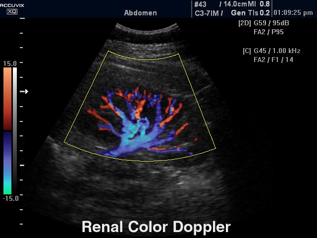 Kidney, color doppler (echogramm №288)