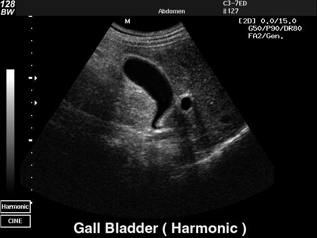 Gall bladder - tissue harmonic, B-mode (echogramm №29)