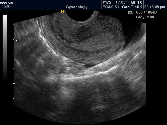Uterus, B-mode (echogramm №291)