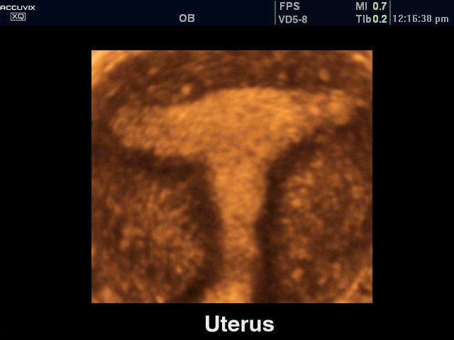 Uterus, 3D (echogramm №292)