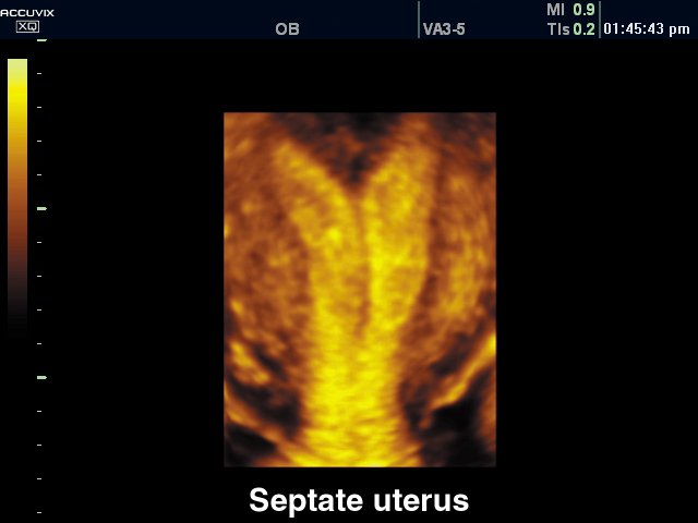 Septate uterus, 3D (echogramm №293)