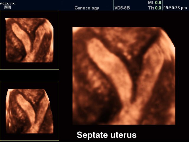Septate uterus, 3D (echogramm №294)