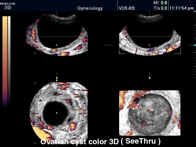 Ovarian cyst, power doppler & 3D (echogramm №295)
