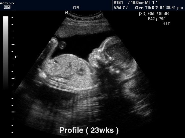 Fetus - 23 weeks, B-mode (echogramm №296)