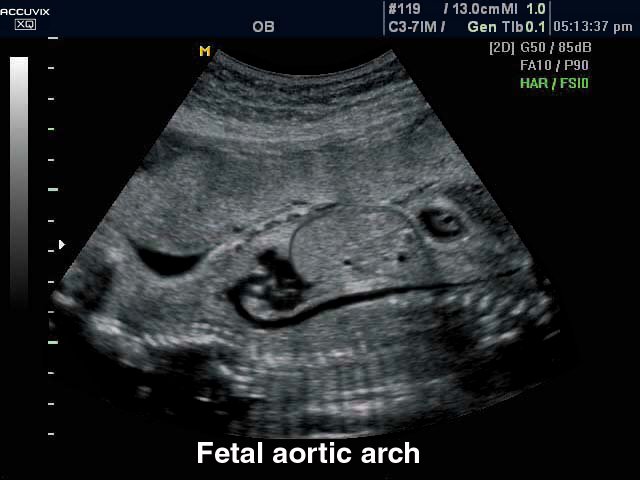 Fetus - arotic arch, B-mode (echogramm №297)
