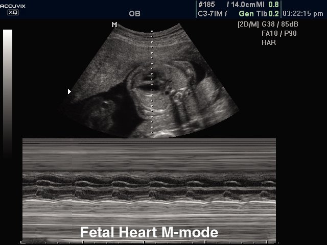 Fetal heart, M-mode (echogramm №299)