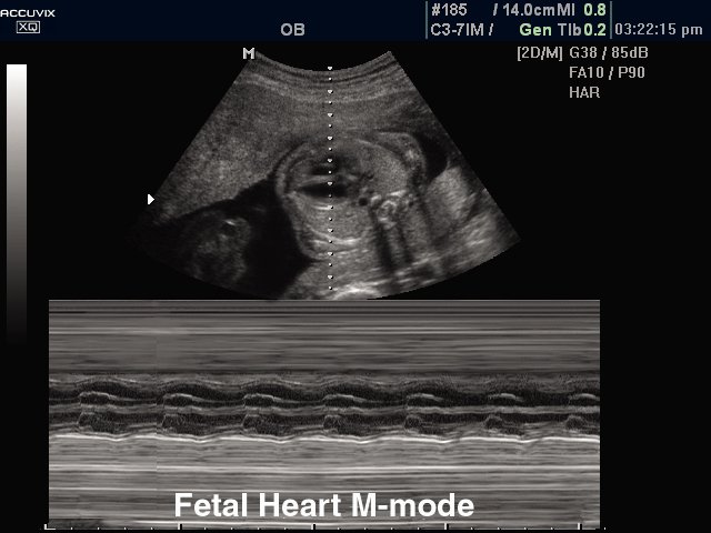 Fetal heart, M-mode (echogramm №299)