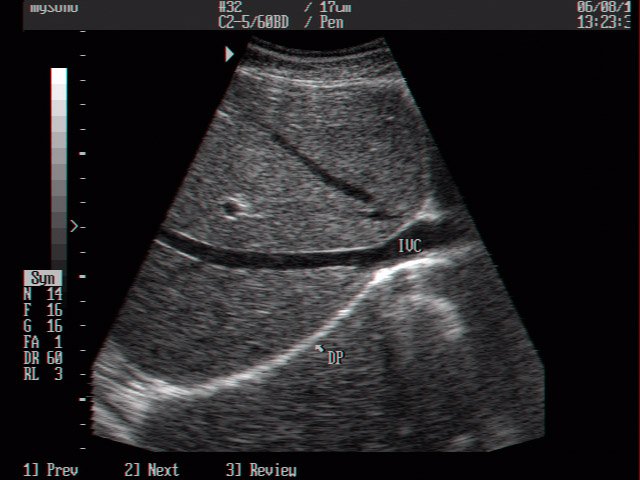 Inferior vena cava, B-mode (echogramm №3)