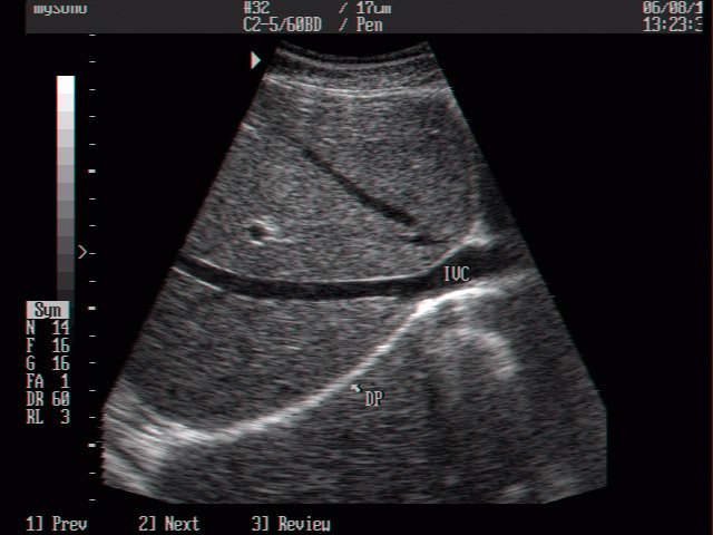 Inferior vena cava, B-mode (echogramm №3)