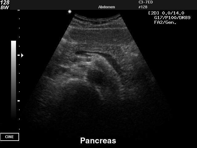 Pancreas, B-mode (echogramm №30)