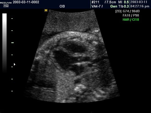 Fetal heart (5 chamber view), B-mode (echogramm №300)