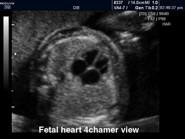 Fetal heart (4 chamber view), B-mode (echogramm №301)
