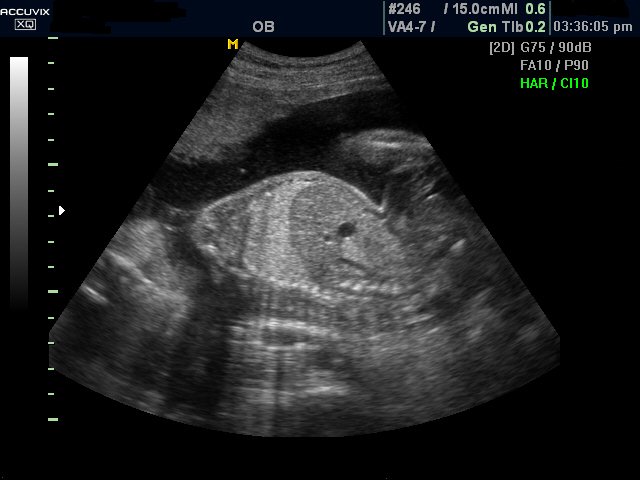 Fetal diaphragm, B-mode (echogramm №302)