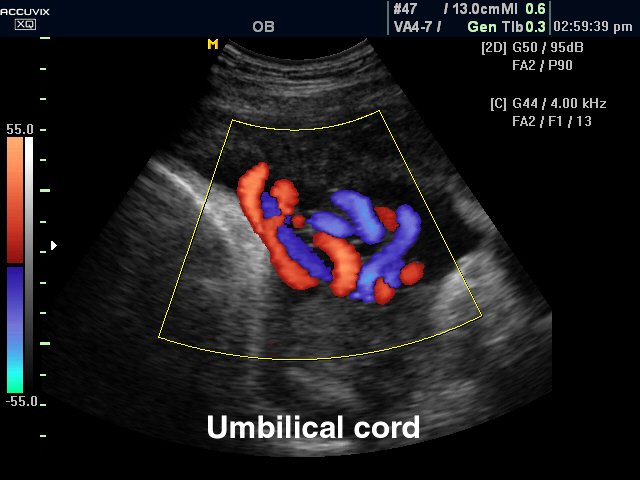 Umbilical cord, color doppler (echogramm №304)