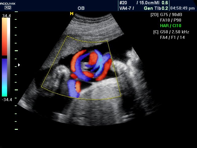 Umbilical cord, color doppler (echogramm №305)