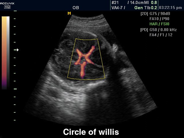 Circle of Willis, power doppler (echogramm №307)